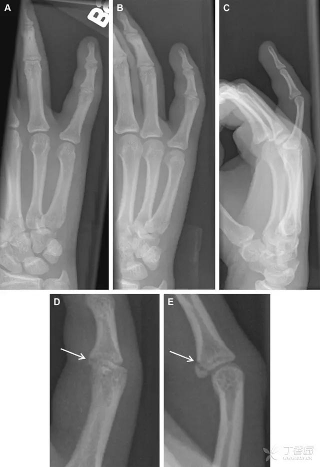 放射科夜班病例大全,放射科容易漏诊的骨折
