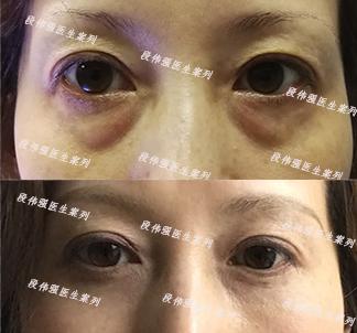 如何消除眼袋与黑眼圈,如何消除眼袋男生