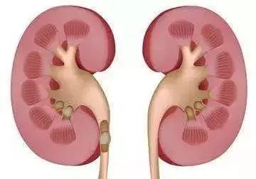 双肾多发结石取出2000多颗,史上最大手术取出肾结石