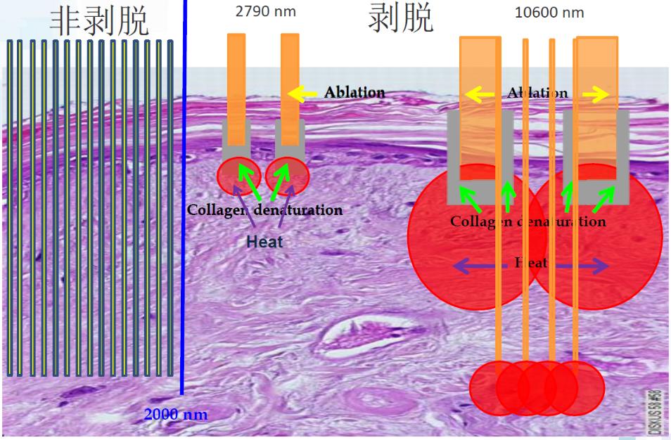 点阵激光的终极效果,超脉冲co2点阵激光效果好吗
