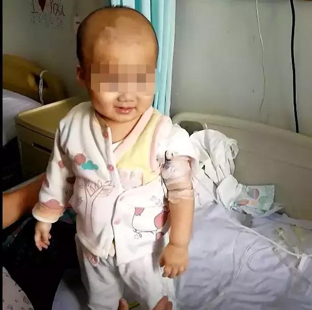 孩子脑积水反复发烧,婴儿脑积水引起发烧如何保守治疗