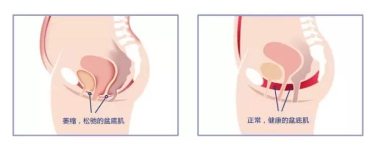 无法控制小便怎么办,为什么生完宝宝后尿的次数多了