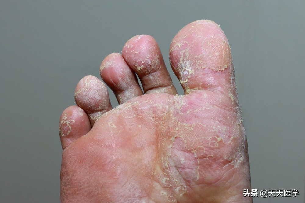 脚气治疗过程中的注意事项,脚气的注意事项