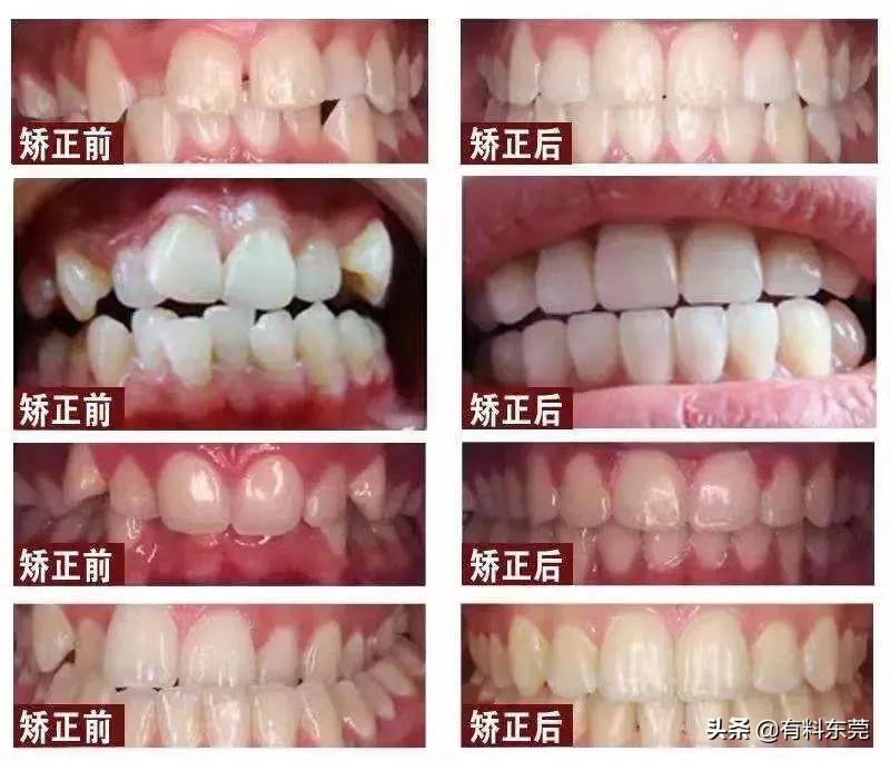 28.8元超声波洁牙！超值88折！让茶山人轻松实现...