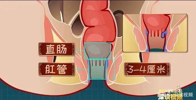 疼，很疼，真的很疼，疼得让你毛焦火乱肛肠病