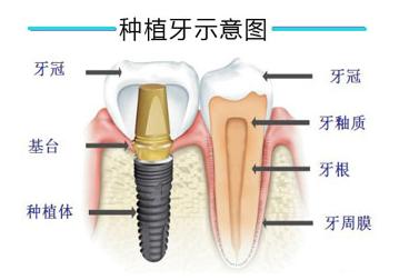 种植牙如何治疗牙髓炎,种植牙能治疗蛀牙吗
