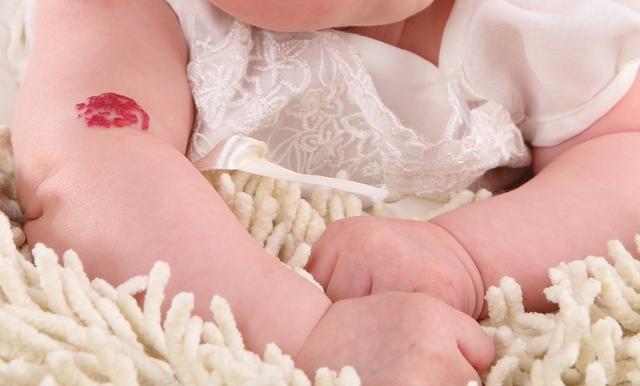 一个月宝宝得了血管瘤怎么办,宝宝身上有血管瘤怎么办