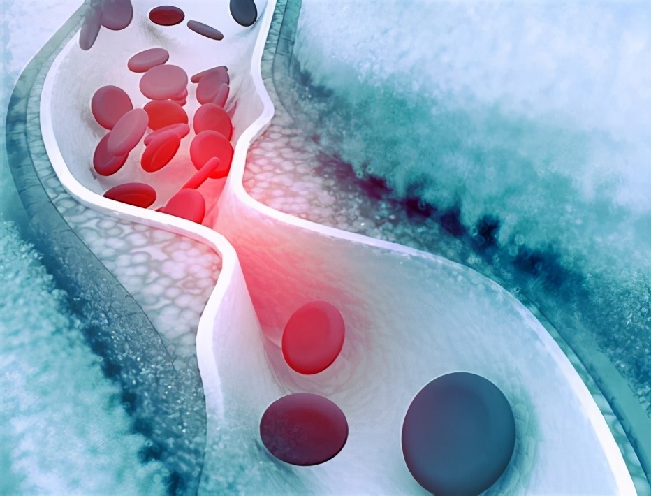 胆固醇要查什么才可以知道,胆固醇有一点点偏高医生没有开药
