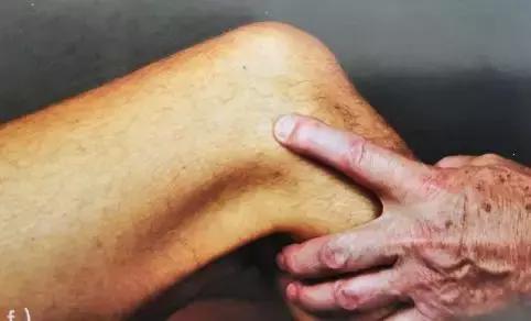 这个伤让他连续三年无缘马拉松！其实1/10的跑者都在被它折磨！