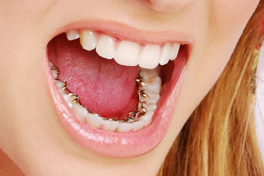 上海舌侧正畸医生,上海舌侧矫正哪家好