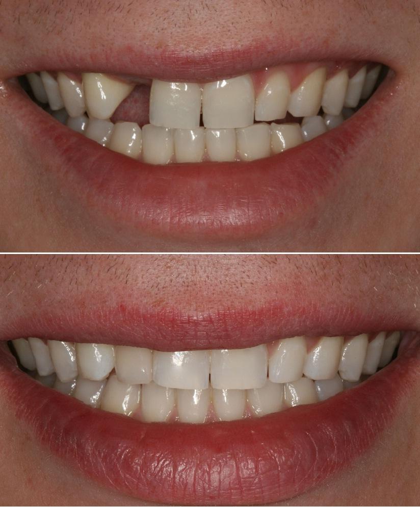 都说种植牙贵难道保护牙齿很难吗,谈谈种植牙对牙床的损害