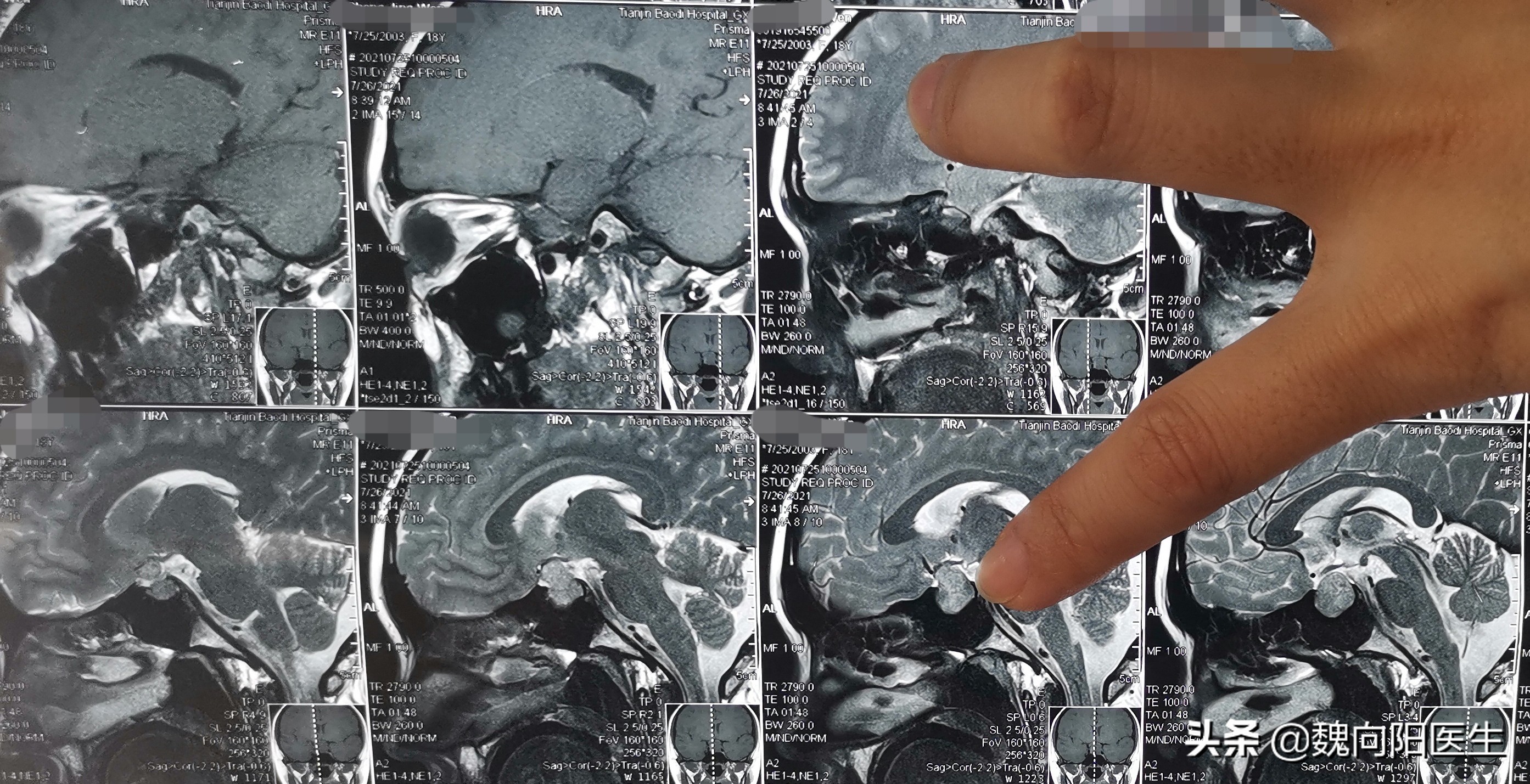 垂体瘤10岁女孩,小孩得了垂体瘤一定要手术吗
