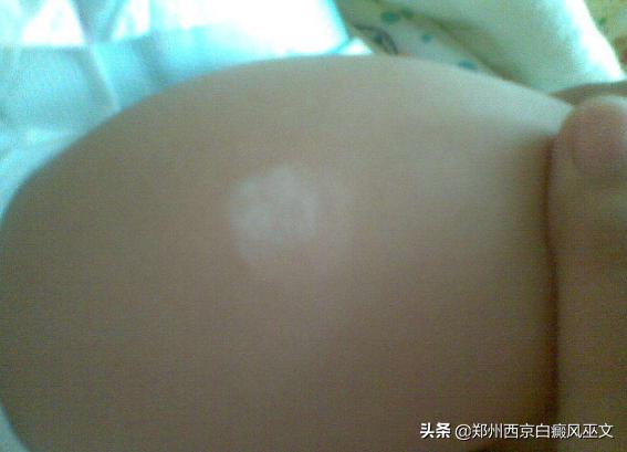 小儿白癜风高发怎么办,2岁儿童怎么确诊白癜风最准确