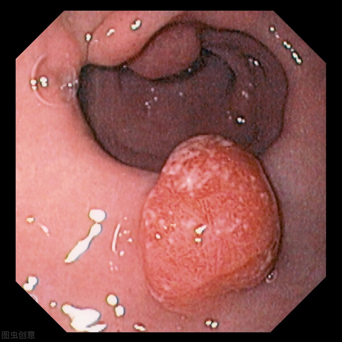 是不是大多数人都有胃息肉,大部人是不是有胃息肉
