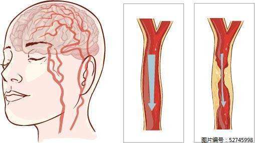 脑梗腿脚没劲怎么治疗,舌头说话不利索和脑梗的关系