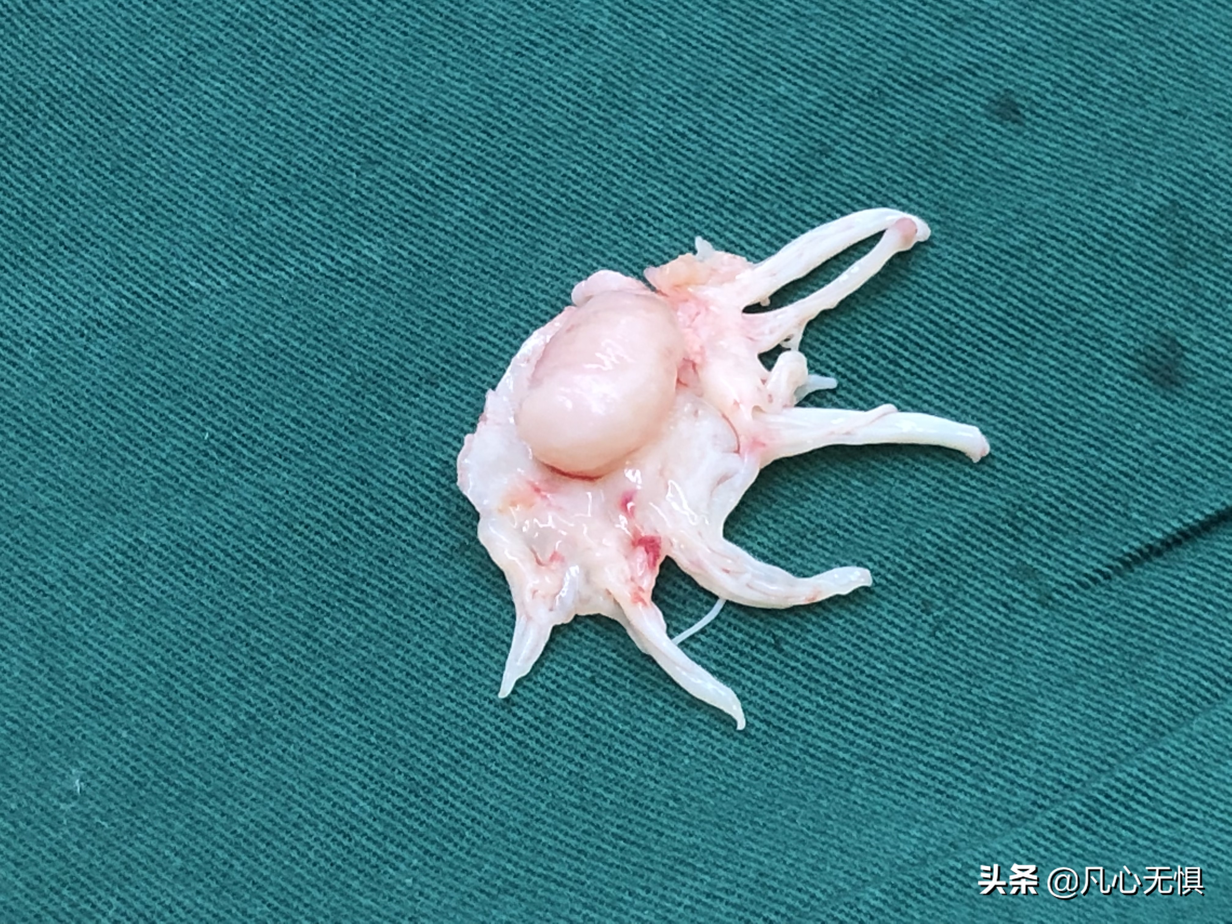 感染性心内膜炎最常受累的部位是,心内膜炎的健康宣教