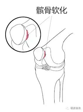 健身教练四个动作缓解膝盖疼痛,健身教练矫正腿型课有用吗