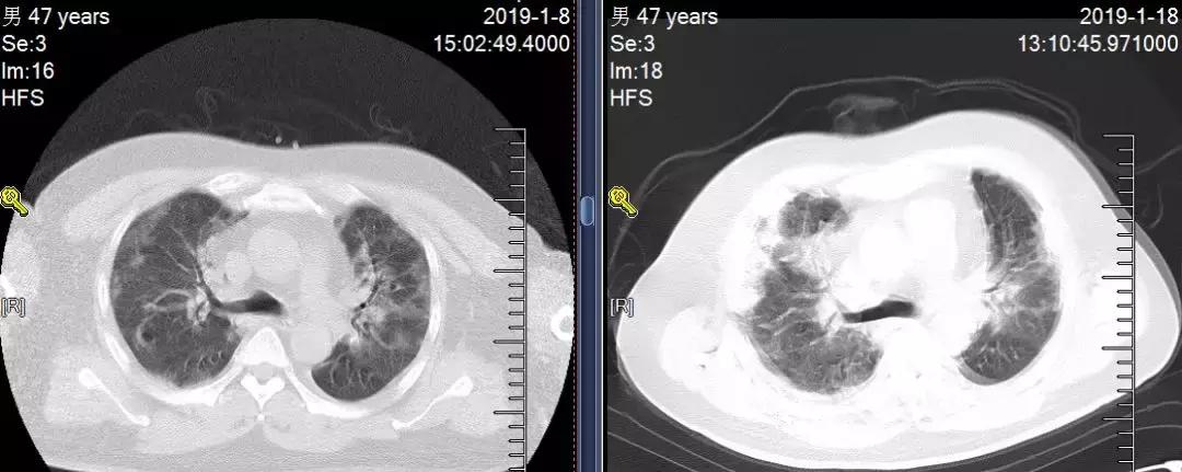 流感重症肺炎患者好转后皮疹、口腔白膜，流感病毒感染如何用激素