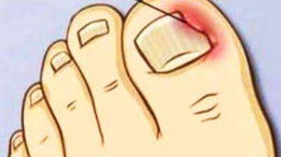 甲沟炎剪指甲好还是不剪好,很多人甲沟炎