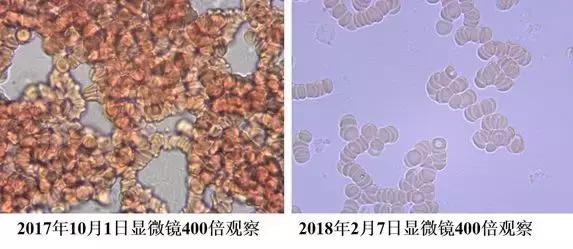 血液粘稠的病因及治疗,健康血液粘稠别小看但也别乱治