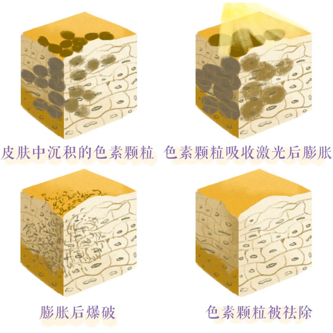 大痘印适合做什么医美,医美做什么可以去除痘坑