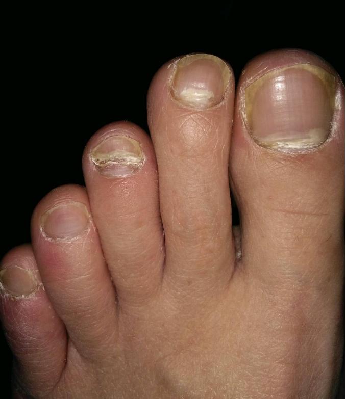 为什么人的小脚指甲是两半的,汉族人脚趾甲分成两半是什么原因