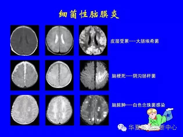 新生儿颅脑mri,新生儿颅脑mr报告模板