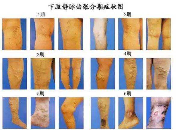 缓解静脉曲张的运动方法3种,缓解腿部静脉曲张最好的药