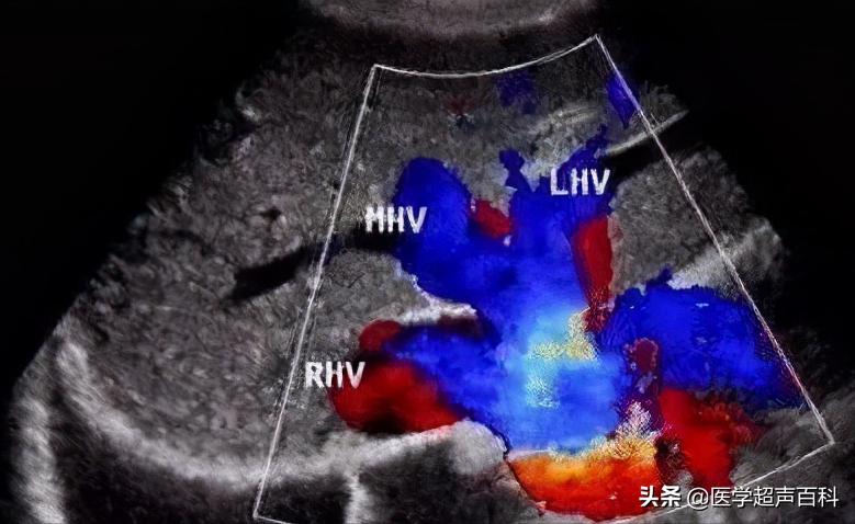 肝上有淤血怎么治疗吃中药,肝淤血的超声诊断标准