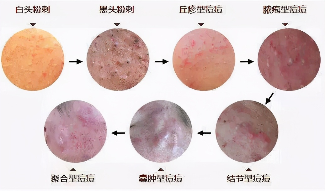 宝宝脸上闭口粉刺怎么办,祛痘痘粉刺闭口