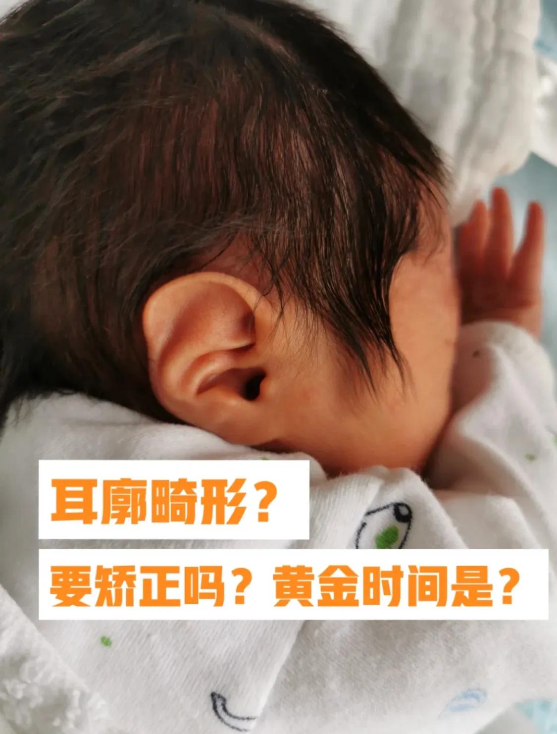 宝宝出生耳廓畸形但是听力正常,刚出生宝宝畸形耳朵图片
