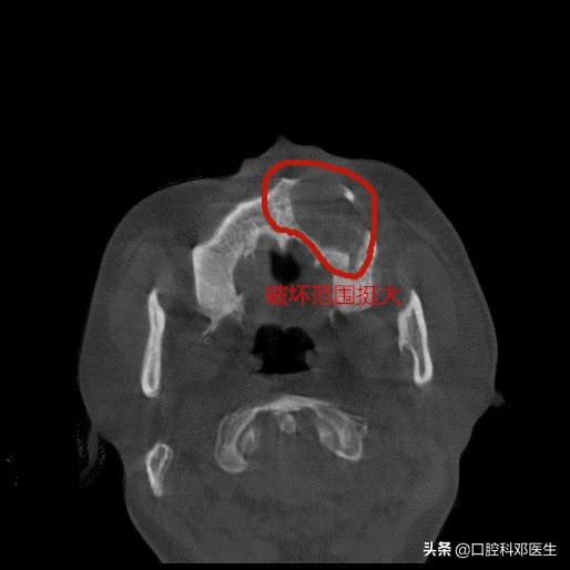上颌左边埋伏阻生牙的拔除视频,埋伏阻生牙拔除会得干槽症吗