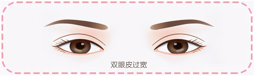 双眼皮宽深修复后三眼皮案例,埋线双眼皮过宽如何修复