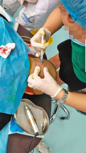 2.5亿脱发人口造就百亿植发生意，不过，动刀的可能是3天速成医师