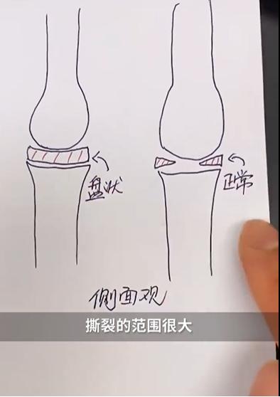 小孩高位截瘫功能锻炼,4岁孩子下腰瘫痪