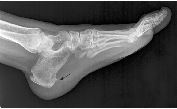 早起脚跟痛脚底板痛肿胀怎么回事,早起脚底板疼走一会又不疼了