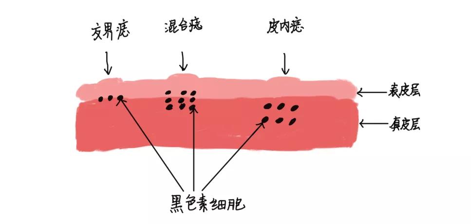 儿童色素痣切除,激光祛除色素痣