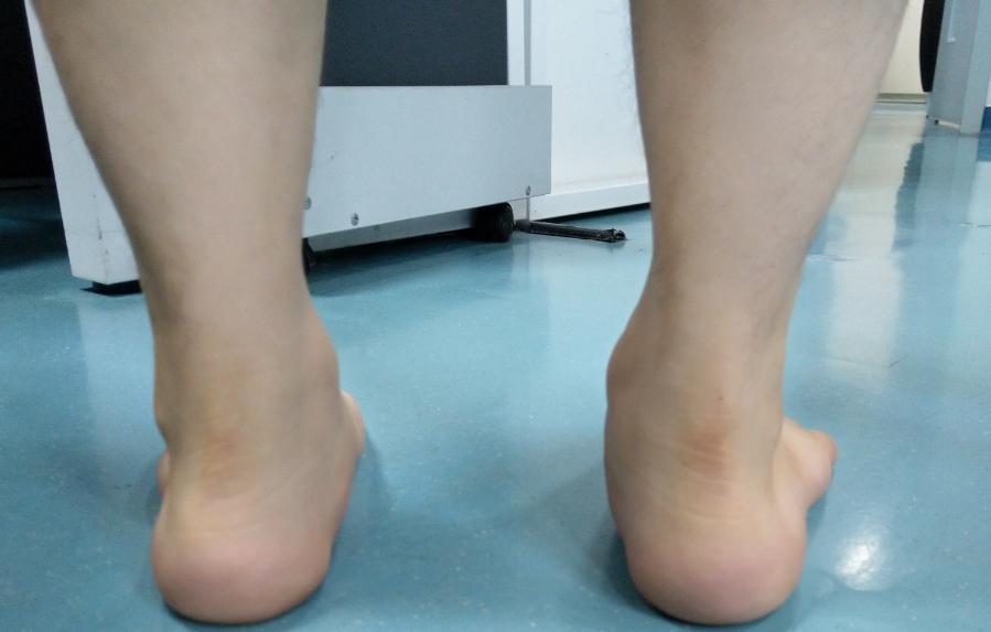 扁平足训练动作,扁平足最佳训练方法