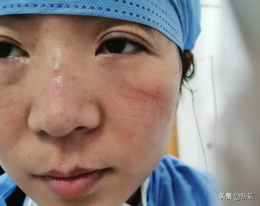 戴口罩久了皮肤屏障会受损吗,戴口罩戴久了鼻子不舒服