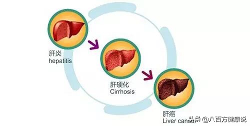 由乙肝引起的肝炎肝癌能治好吗,乙肝转肝癌从早期到晚期要多久