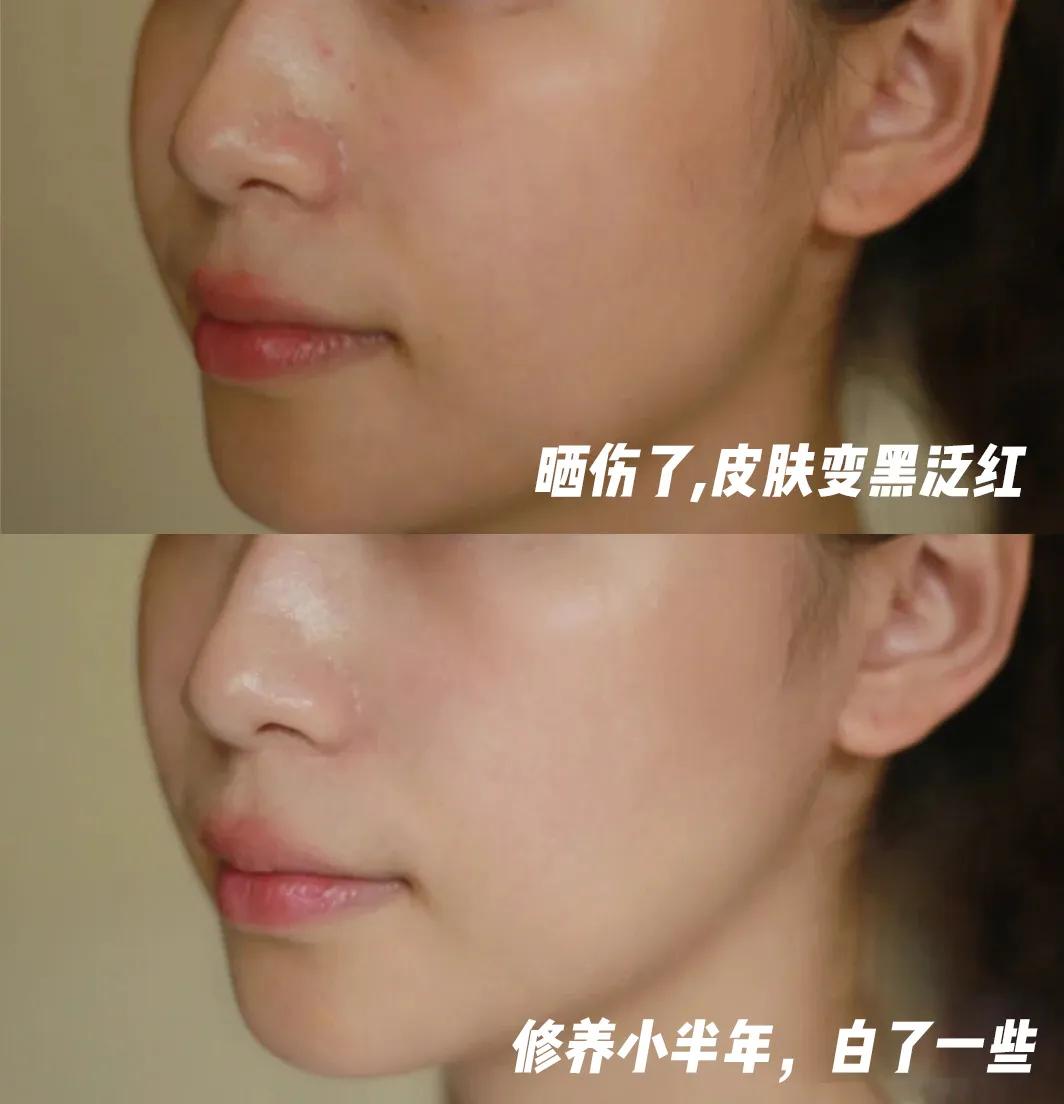 韩国皮肤美白神器,脸部晒黑美白神器