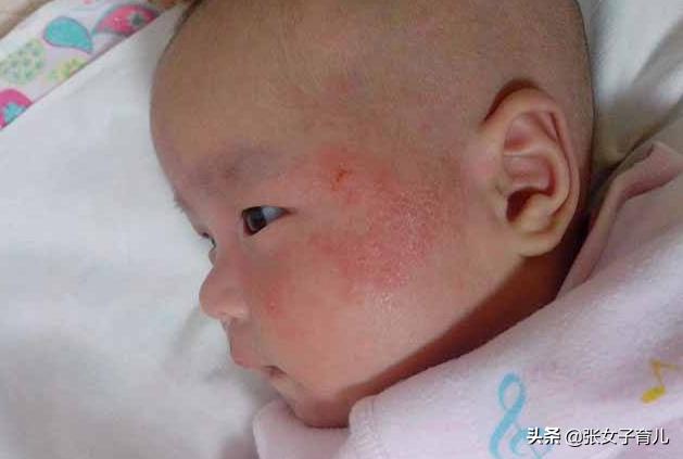 夏天宝宝长痱子有什么好办法吗,宝宝一到夏天就长痱子怎么办