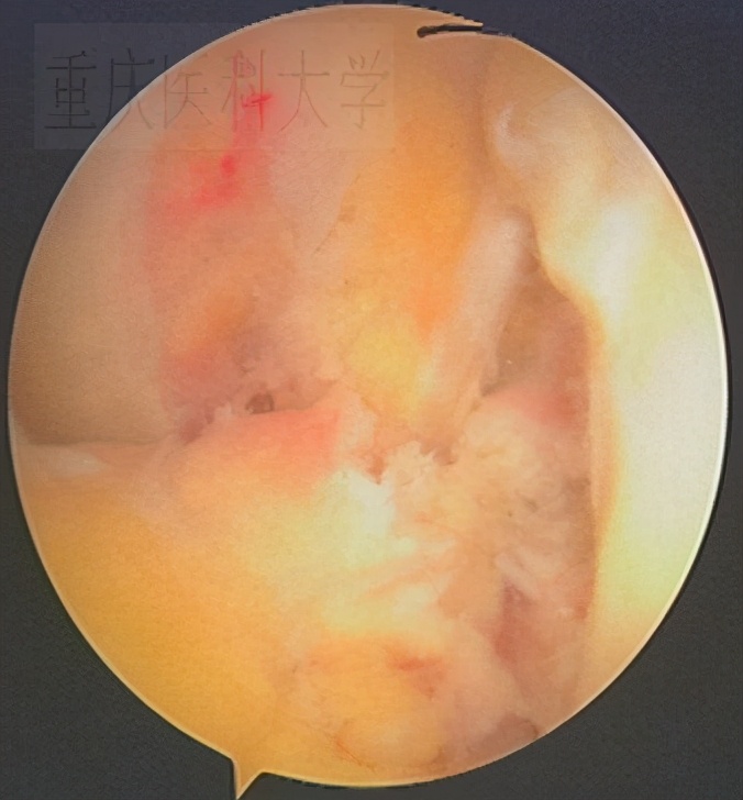 前交叉韧带损伤核磁共振,前后交叉韧带损伤的治疗