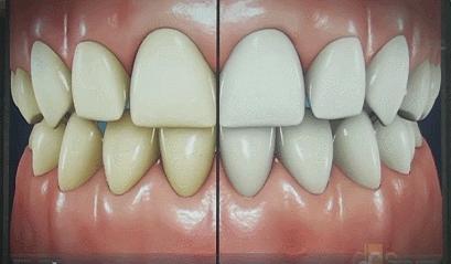 用美牙仪牙齿疼,美牙仪真的有用吗