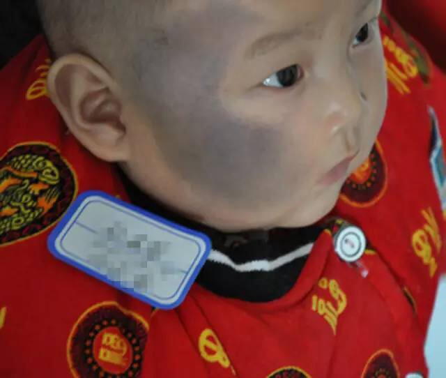宝宝一出生就有雀斑样痣吗,出生的婴儿皮肤有黑斑怎么回事