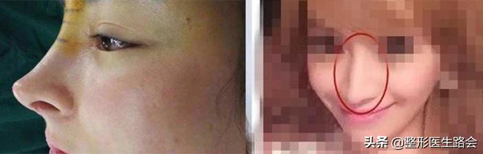 什么样的鼻子才算挺,什么样的鼻子才算有肉