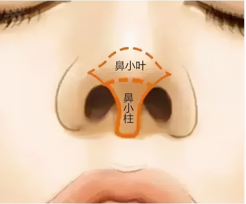 提高鼻小柱最好的方法,鼻小柱抬高改善突嘴