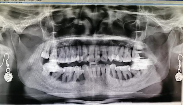 年轻人什么情况会牙齿掉光,30多岁牙齿掉光了是什么造成的