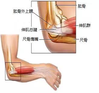 为什么不会打网球还能患上网球肘,不打网球的人会患上网球肘吗