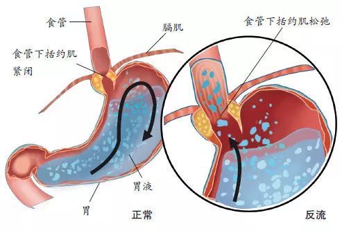 医生为啥说反酸是正常的,反酸为什么难治